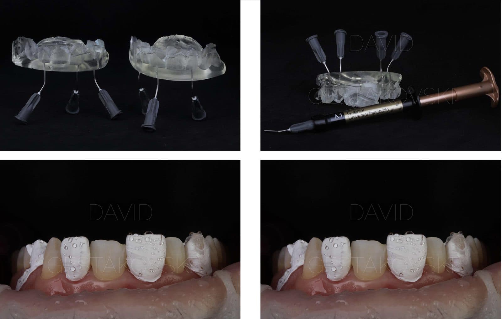 Flowable Injection Anteriors Hands-On Kurs