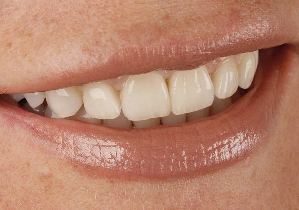 Veneer Präparation