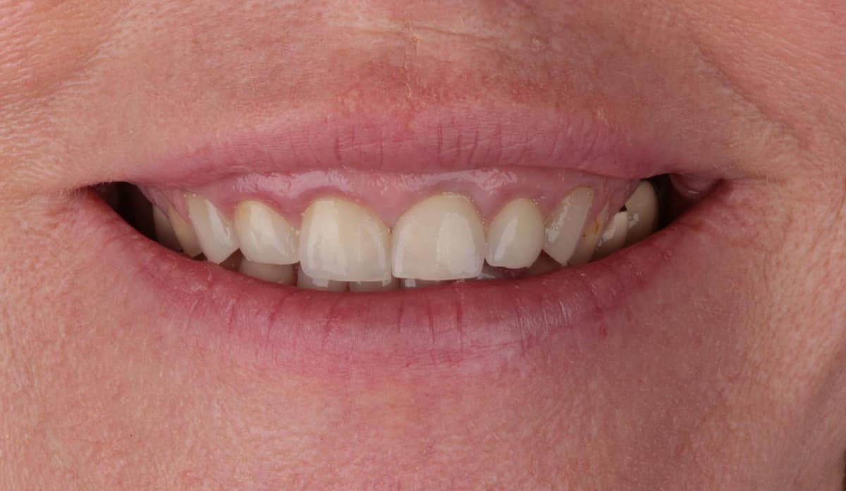 Die Korrektur eines Gummy Smile