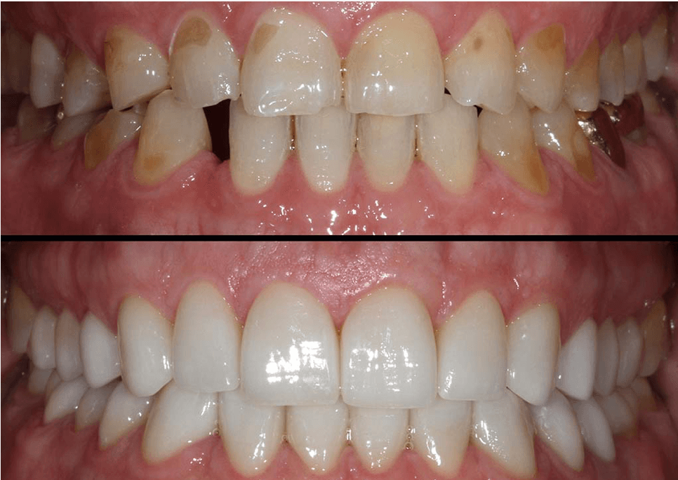 Bite Correction & Bite Alignment