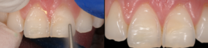 Präparation der Zähne
