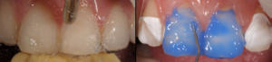 Reinigung der Zähne / Anätzen des Zahnschmelzes