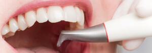 Beispiel Professionelle Zahnreinigung