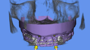 Implantat Röntgen und 3D Überlagerung