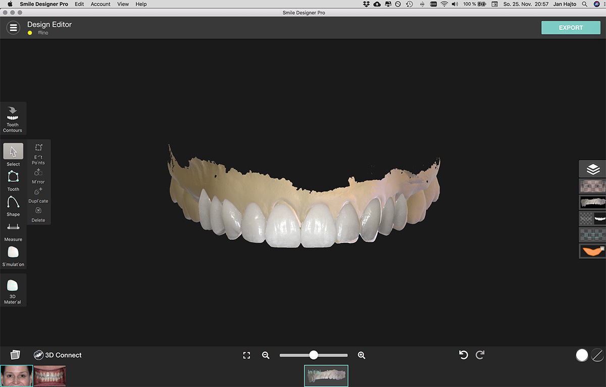 Smile Design 3D Scan