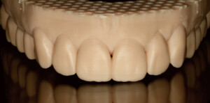 3D Druck Zahn Modell
