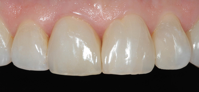 Zahnbehandlung Zahnfleisch Entzündung und Verfärbungen bei undichter Zahnkrone – nachher