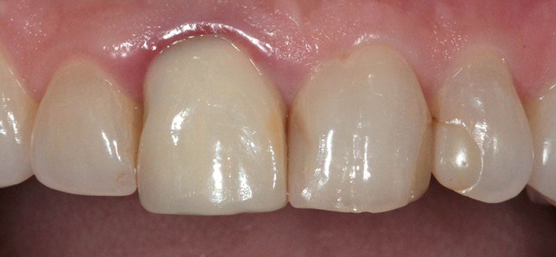 Zahnbehandlung Zahnfleisch Entzündung und Verfärbungen bei undichter Zahnkrone – vorher