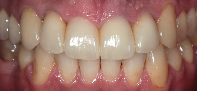 Zahnbehandlung Komplexe Ästhetische Zahnheilkunde – nachher