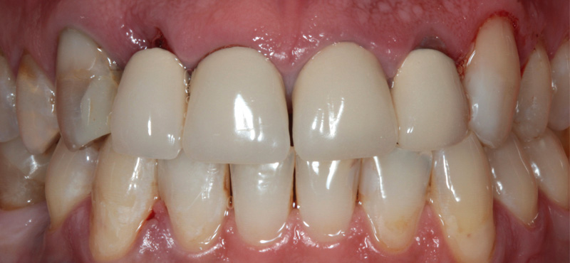 Zahnbehandlung Komplexe Ästhetische Zahnheilkunde – vorher