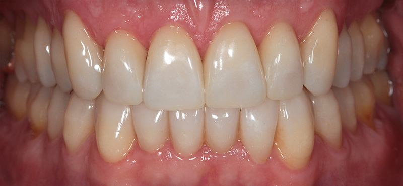 Zahnbehandlung Funktion und Ästhetik – nachher