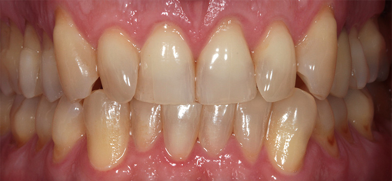 Zahnbehandlung Funktion und Ästhetik – vorher