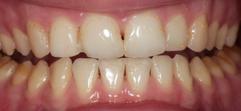 Zahnbehandlung Umfangreiche Gebisssanierung bei Schmelzfehlbildung – vorher