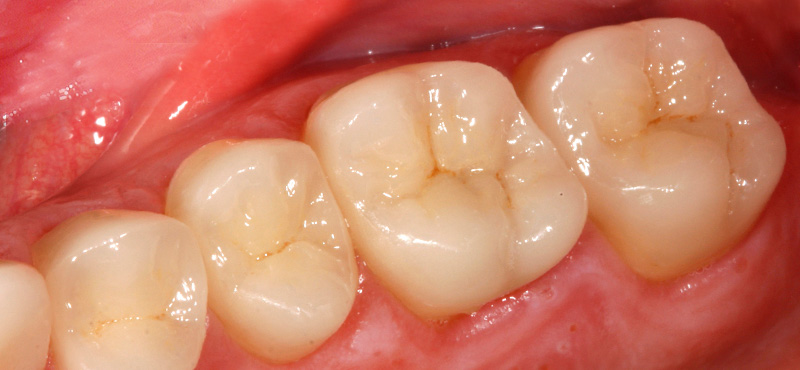 Zahnbehandlung Alte Amalgam Füllung und Karies – nachher