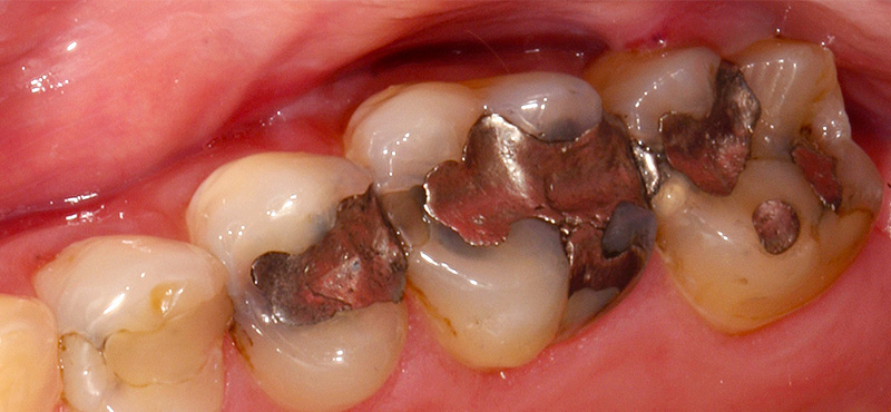 Zahnbehandlung Alte Amalgam Füllung und Karies – vorher