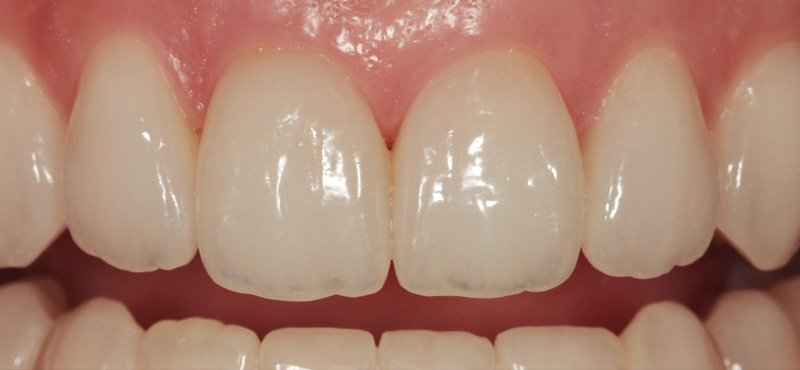 Zahnbehandlung Schneidezahn Veneers bei starker Abnutzung und CMD Behandlung – nachher