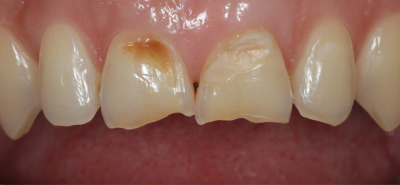 Zahnbehandlung Schneidezahn Veneers bei starker Abnutzung und CMD Behandlung – vorher