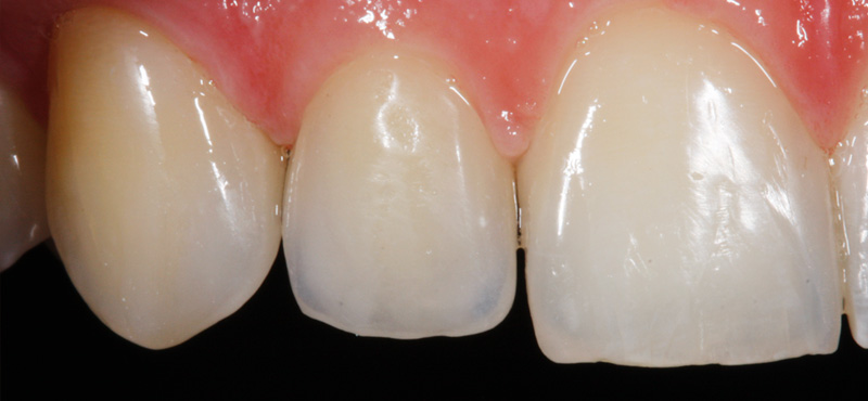 Zahnbehandlung Schliessen von Zahnlücken mit Veneers – nachher