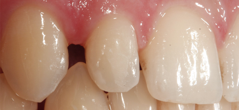 Zahnbehandlung Schliessen von Zahnlücken mit Veneers – vorher