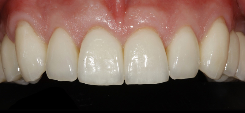 Zahnbehandlung Komplettversorgung von Zähnen mit Implantaten und Kronen – nachher