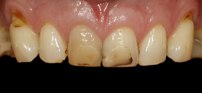 Zahnbehandlung Komplettversorgung von Zähnen mit Implantaten und Kronen – vorher