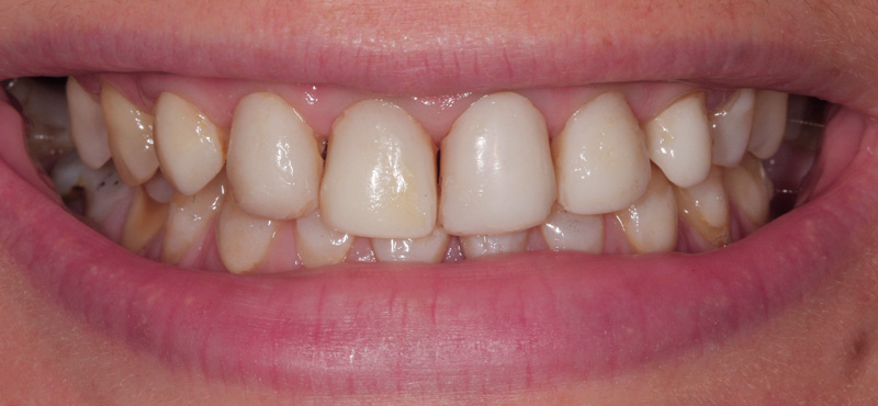 Zerstörung der Zähne durch Bulimie vorher
