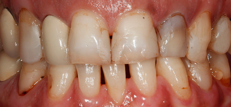 Neuversorgung aller Zähne erfolge mit Vollkeramik-Veneers vorher