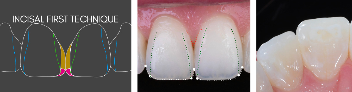 Direct Anterior Restaurations: The One Composite Course by Agne Malisauskiene - Image 1