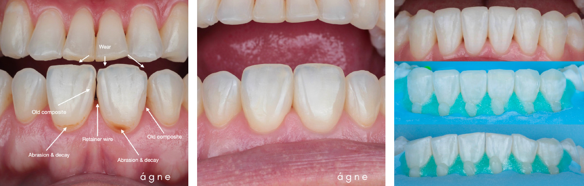 Direct Anterior Restaurations: The One Composite Course by Agne Malisauskiene - Image 2