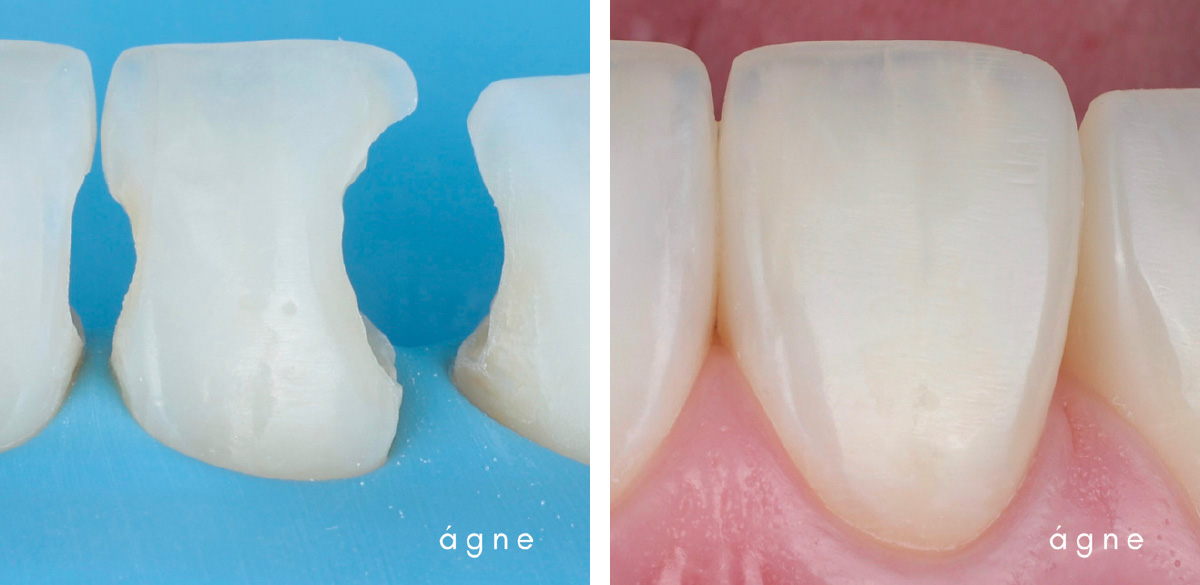 Direct Anterior Restaurations: The Two Composite Course by Agne Malisauskiene - Image 1