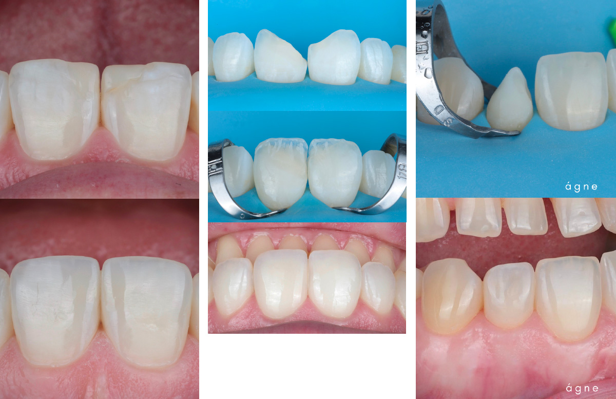 Direct Anterior Restaurations: The Two Composite Course by Agne Malisauskiene - Image 2