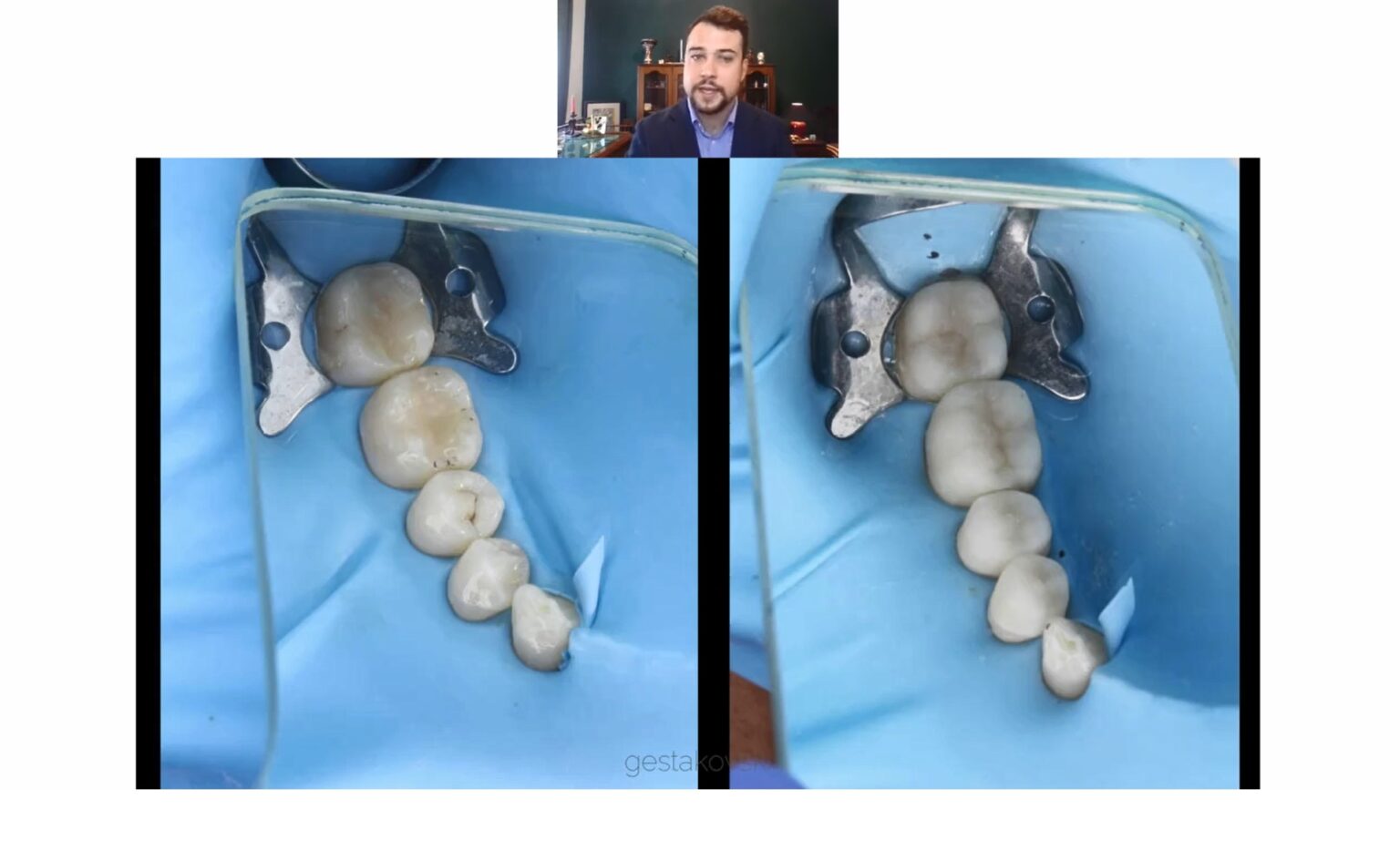 Course Online Part 1 - Injectable Technique – Composite Tabletops in Distal Teeth by David Geštakovski