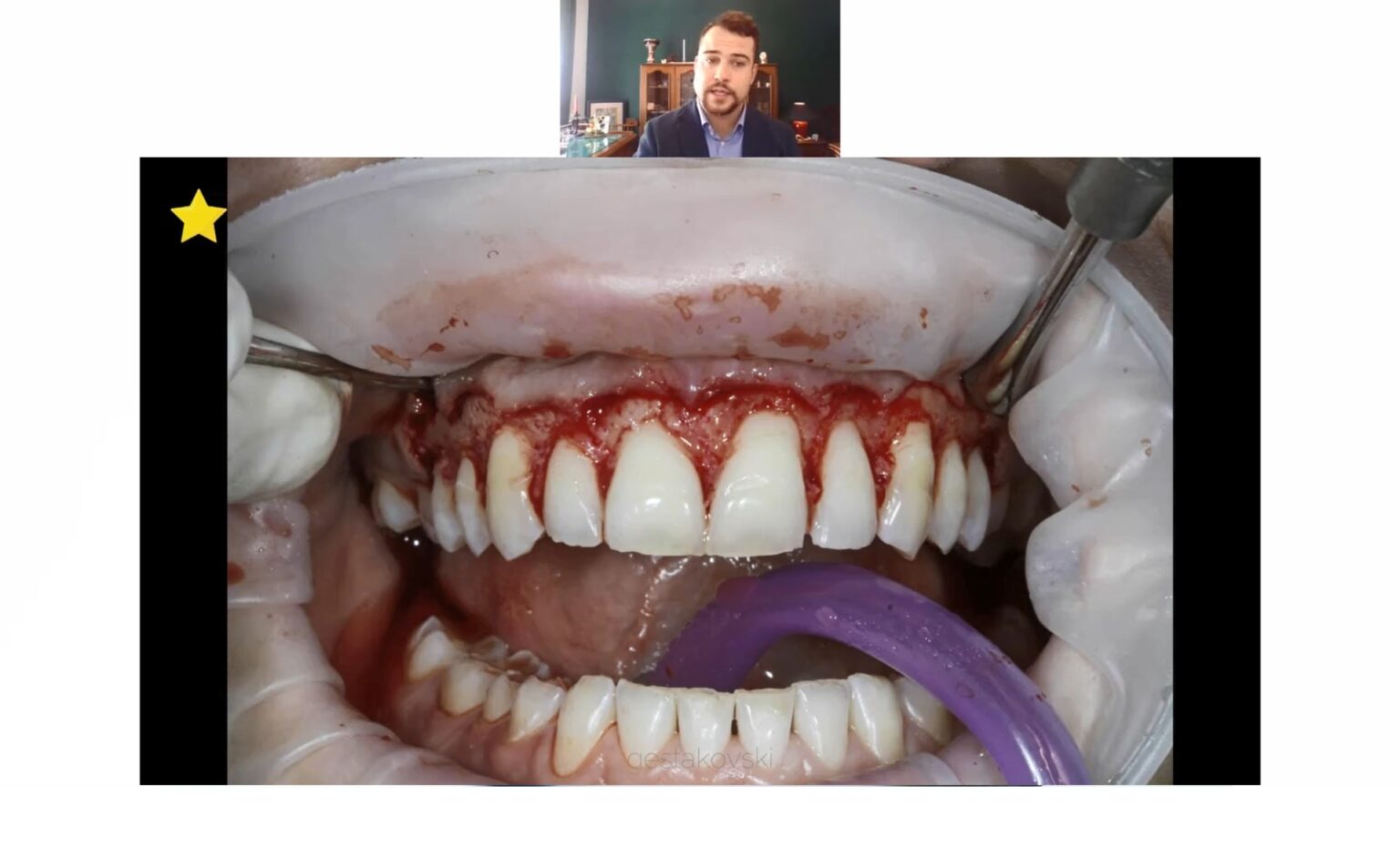 Course Online Part 3 - Injectable Technique – Composite Tabletops in Distal Teeth by David Geštakovski
