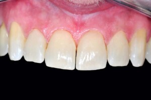 Komposit Füllungen Fall 2 nachher