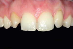 Komposit Füllungen Fall 3 vorher