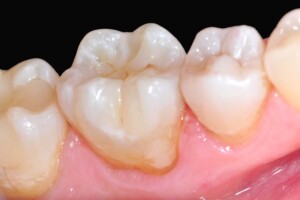 Komposit Füllungen Fall 4 Nr. 3